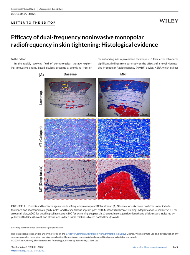 Effectiviteit van dual-frequentie niet-invasieve monopolaire radiofrequentie bij huidverstrakking: histologisch bewijs