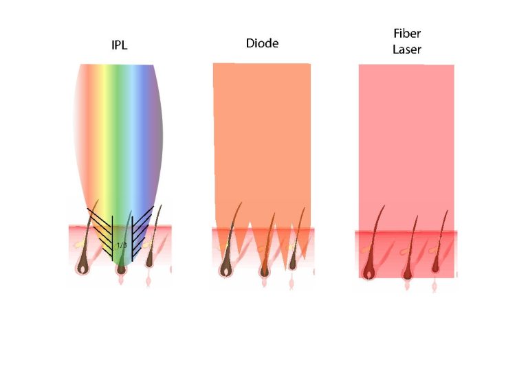 La différence entre les différentes méthodes d'épilation au laser expliquée visuellement
